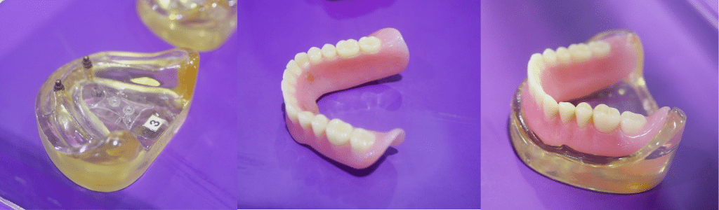 permanent dentures need know denture during recovery eating including tips through guide